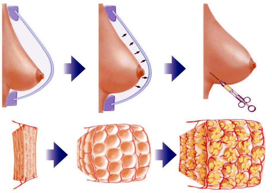 Cirurgia de aumento de mama