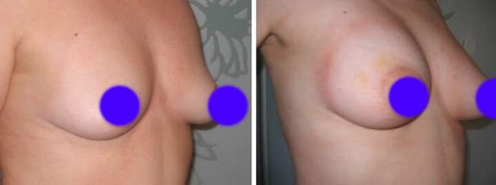 Seios antes e depois da introdução de enchimentos com base no ácido hialurônico
