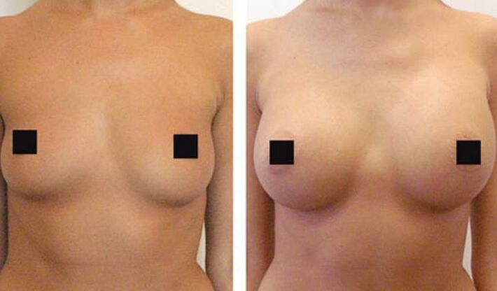 Seios antes e depois do aumento do ácido hialurônico