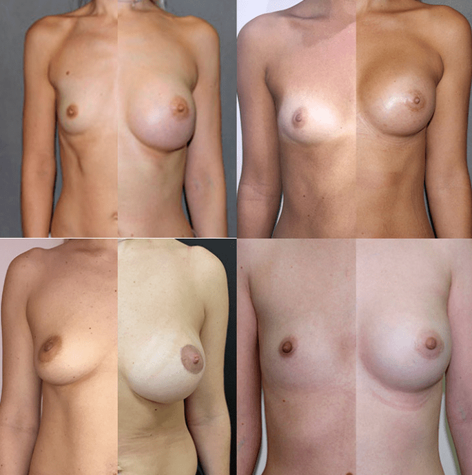 Foto antes e depois da mamoplastia do peito