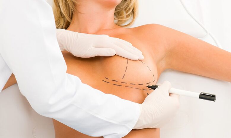 Marcada de mama de mamoplastia