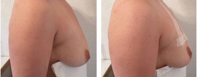 Antes e depois da elevação dos seios com fio