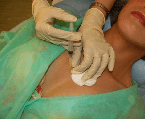 Introdução de meso-coquetel no tecido mamário - uma alternativa às injeções de ácido hialurônico