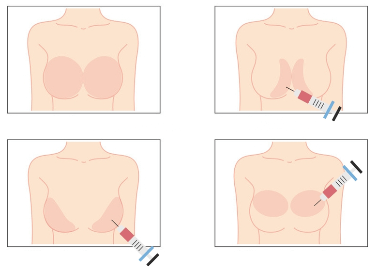 Locais para injeção de ácido hialurônico na mama