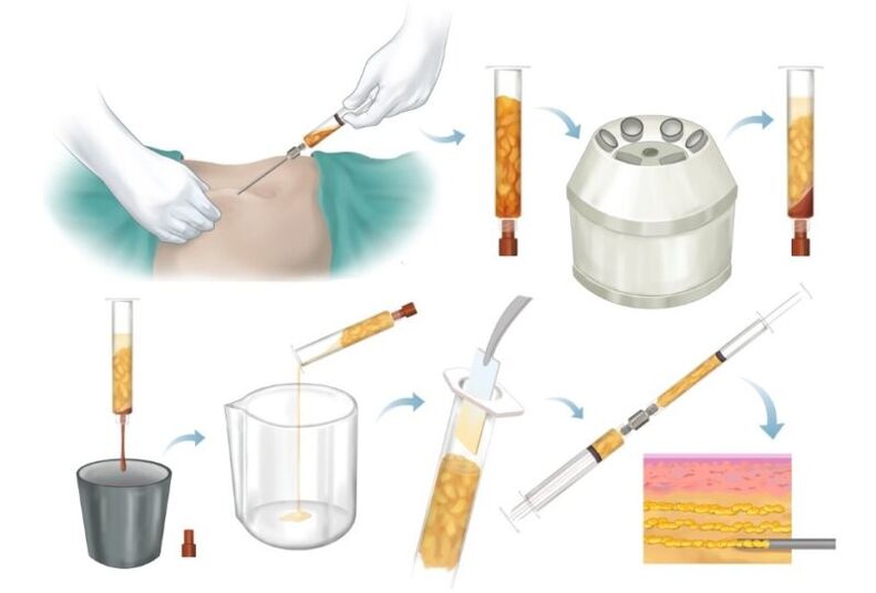 Remoção de gordura de áreas problemáticas, processamento e injeção no tecido mamário