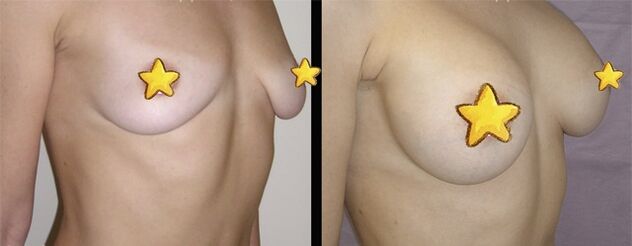 antes e depois da mamoplastia de aumento