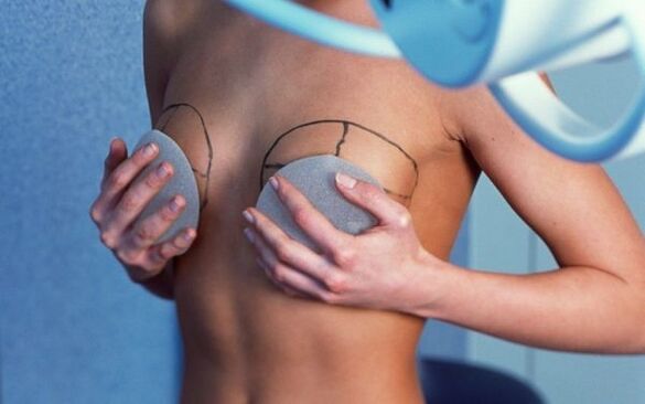 aumento de mama com implantes